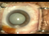 Cirugía combinada de glaucoma y catarata por dos vías.