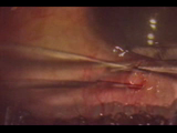 Cirugía combinada de glaucoma y catarata por la misma vía.